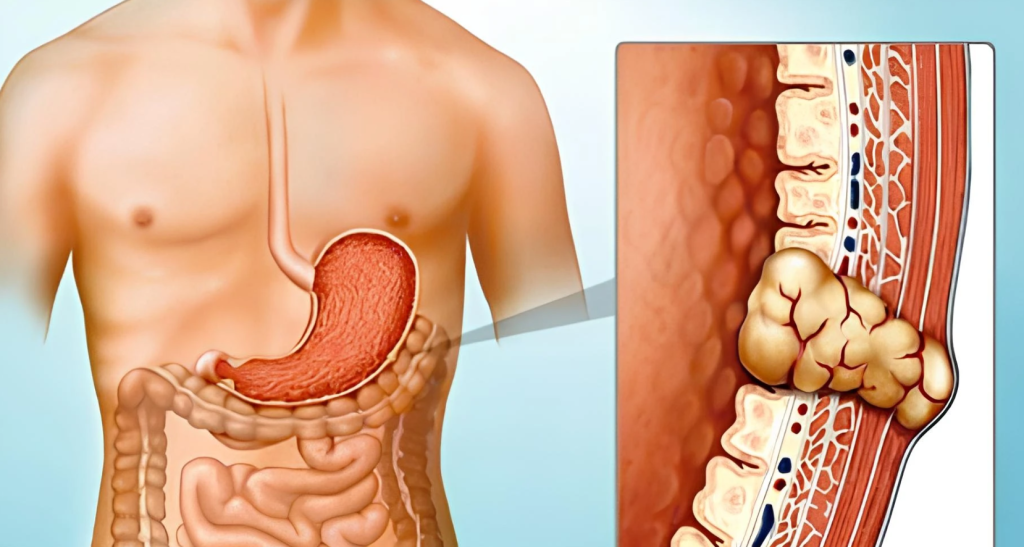 Illustration of GIST tumour, a type of tumour that occurs in the digestive tract