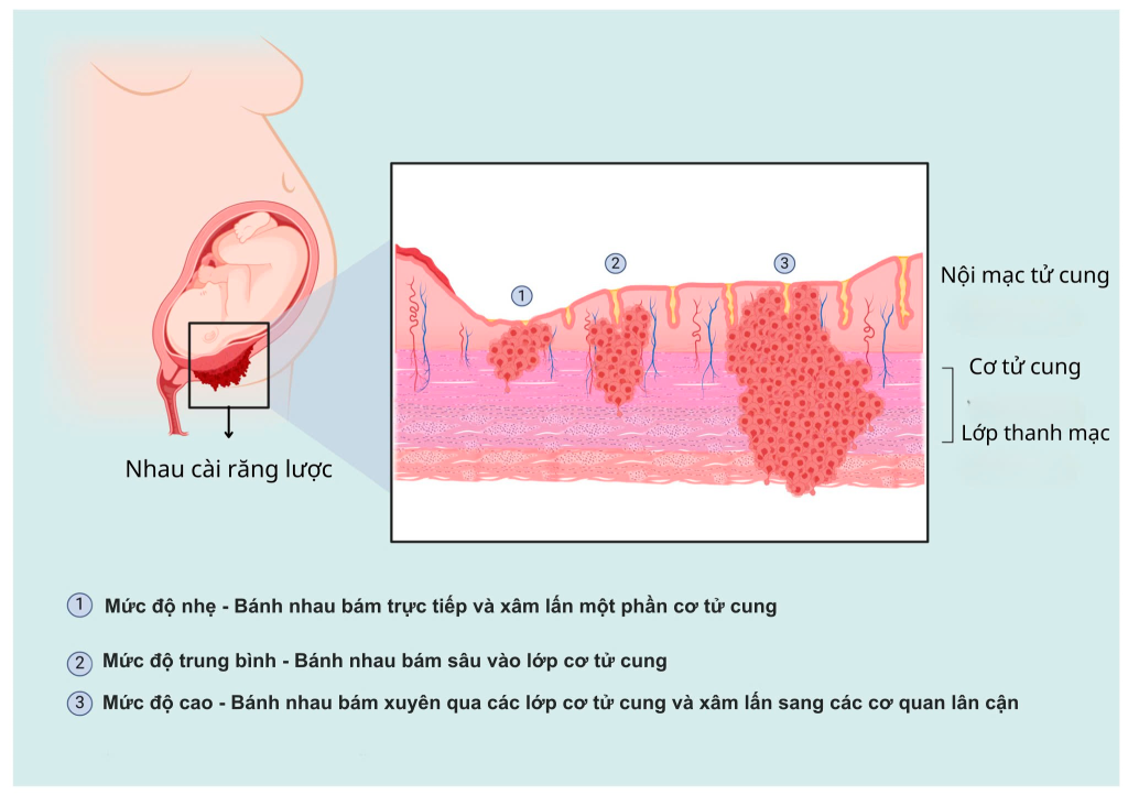 Nhau cài răng lược có thể dẫn đến biến chứng băng huyết sau sinh 