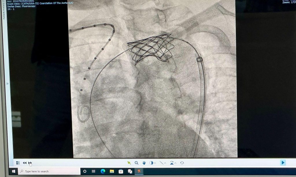 Hình ảnh stent động mạch chủ được chụp lại sau khi đã đặt thành công