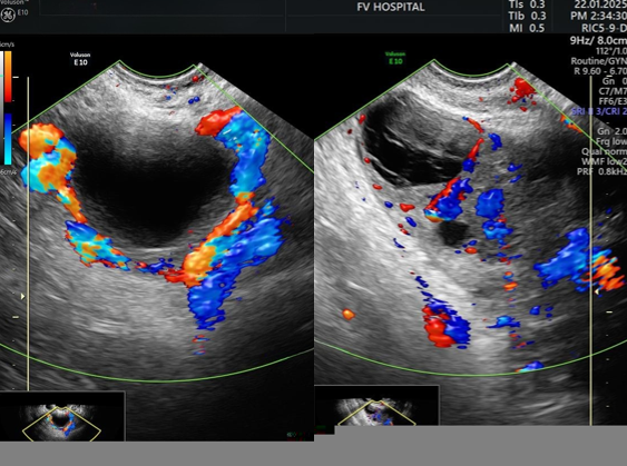 The ultrasound image of the ovary shows normal blood flow after one week of follow-up (the left side is normal, while the right side had previously been twisted).