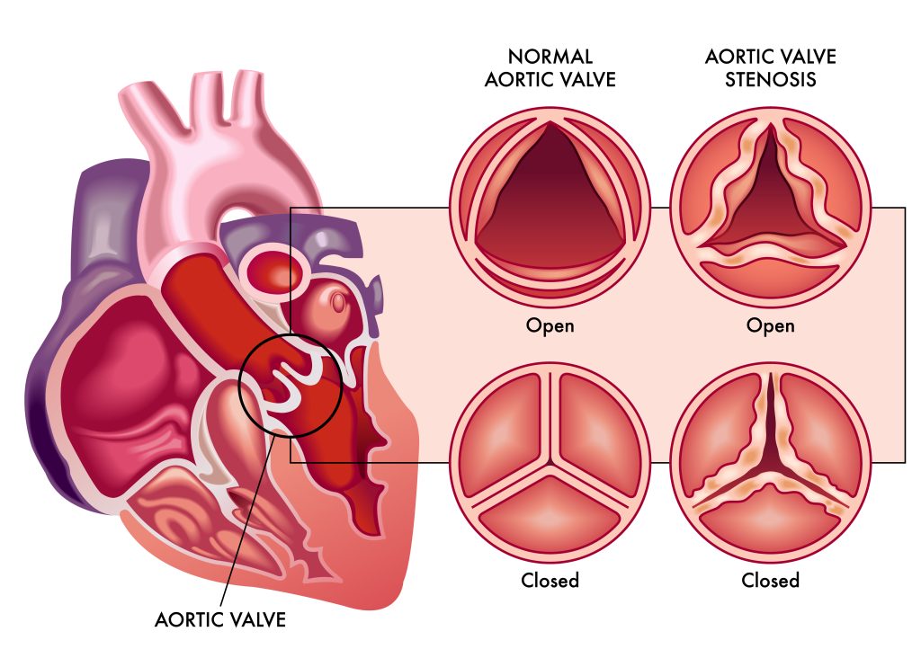 Aortic valve stenosis obstructs the blood flow through the heart.