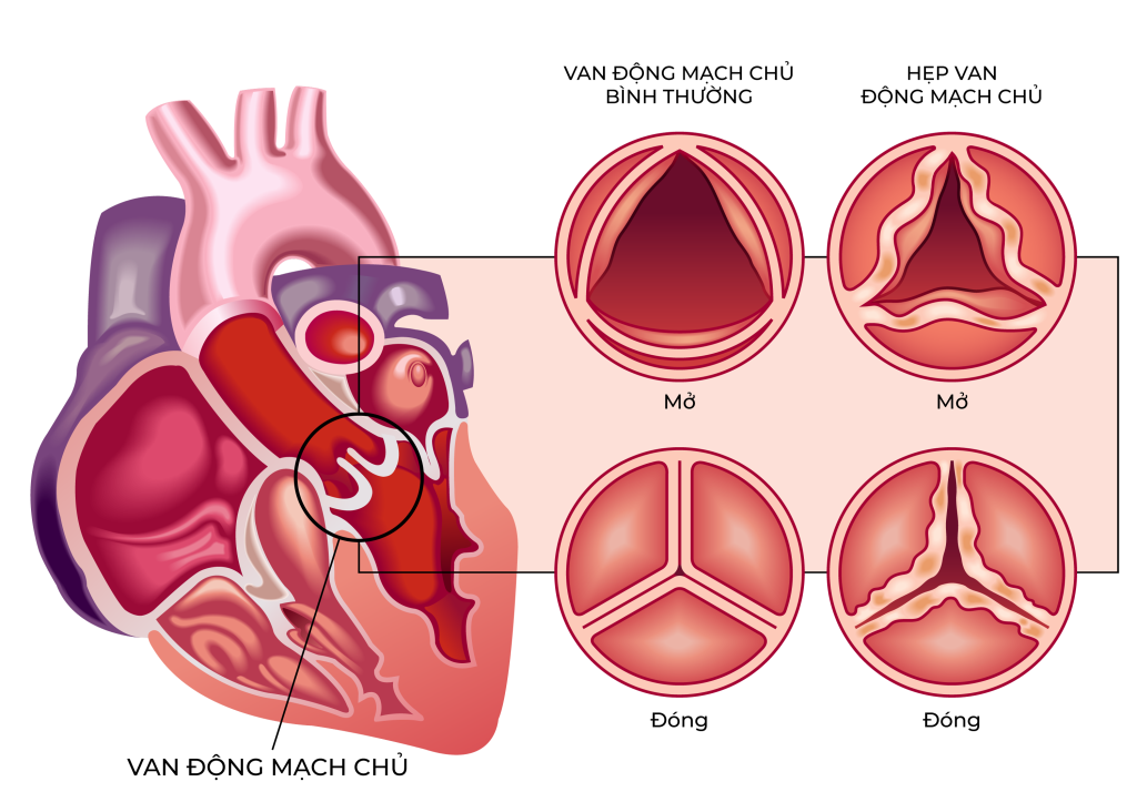 Hẹp van động mạch chủ làm cản trở quá trình lưu thông máu của tim