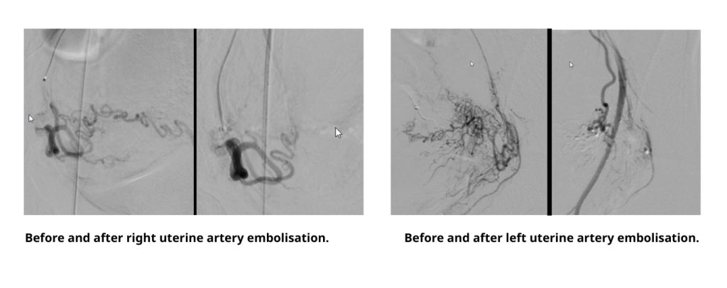 Before and after uterine artery embolisation (UAE)