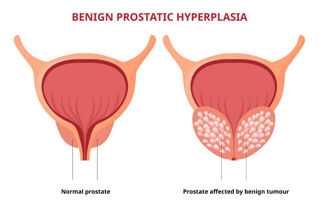 Illustration comparing a normal prostate with one affected by benign tumour.