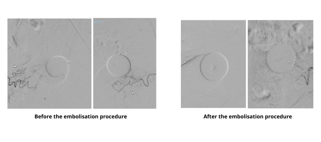 DSA images before and after the embolization procedure. The prostate artery has been completely embolized.