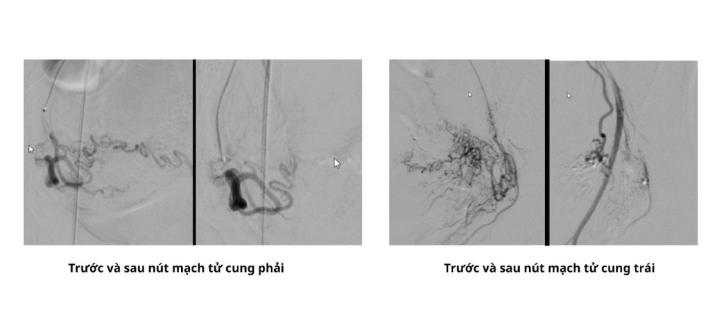 Hình trước và sau nút mạch tử cung