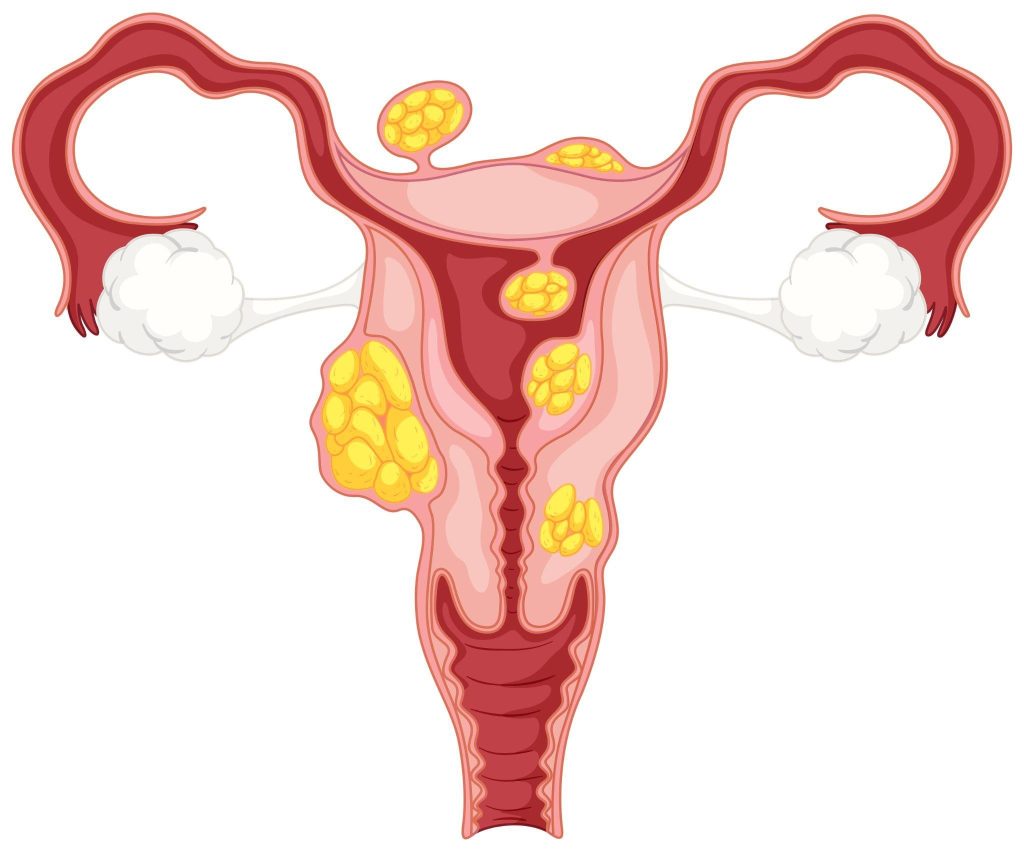 Uterine fibroids affect approximately 30% of women over 30 years old.