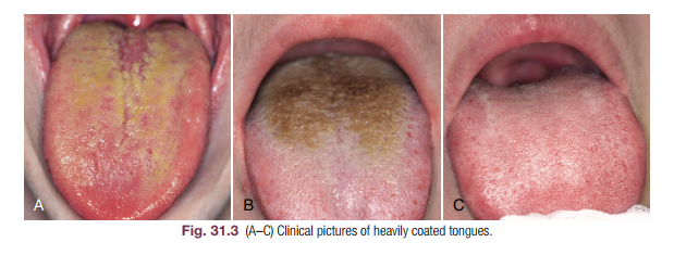 Tongue coating on the surface, a common cause of bad breath.