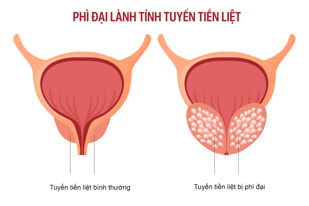 Minh họa tuyến tiền liệt bình thường và khi bị bướu lành tính 