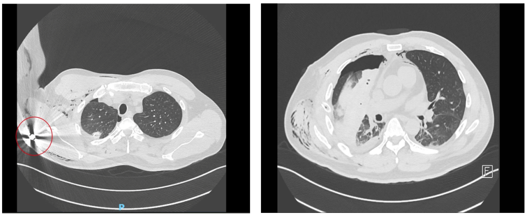 The bullet pierced and destroyed the patient’s right lung lobe before becoming lodged inside the body