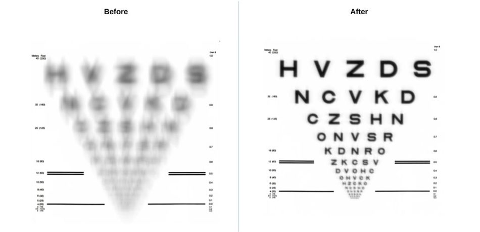 Actual imaging results from the same patient – just one day after ClarityX treatment
