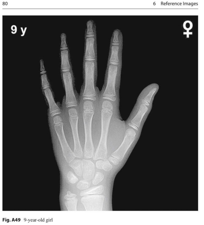 Example of a hand X-ray used to assess bone age in children