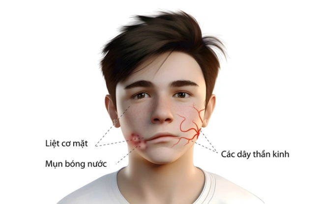 Zona thần kinh gây nhiều biến chứng nghiêm trọng