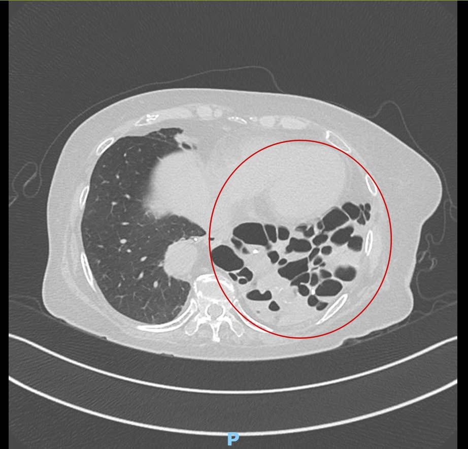 CT scan reveals severe damage to the patient’s left lung