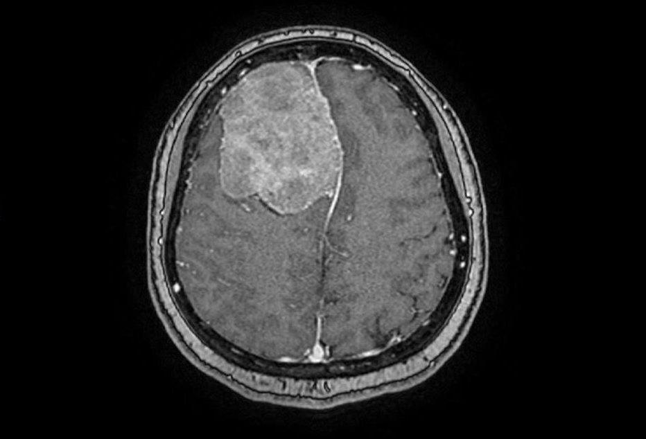 MRI reveals orange-sized tumour in patient’s brain.