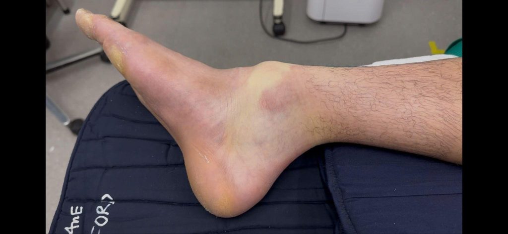A patient sustained a complex ankle fracture-dislocation while playing Pickleball.