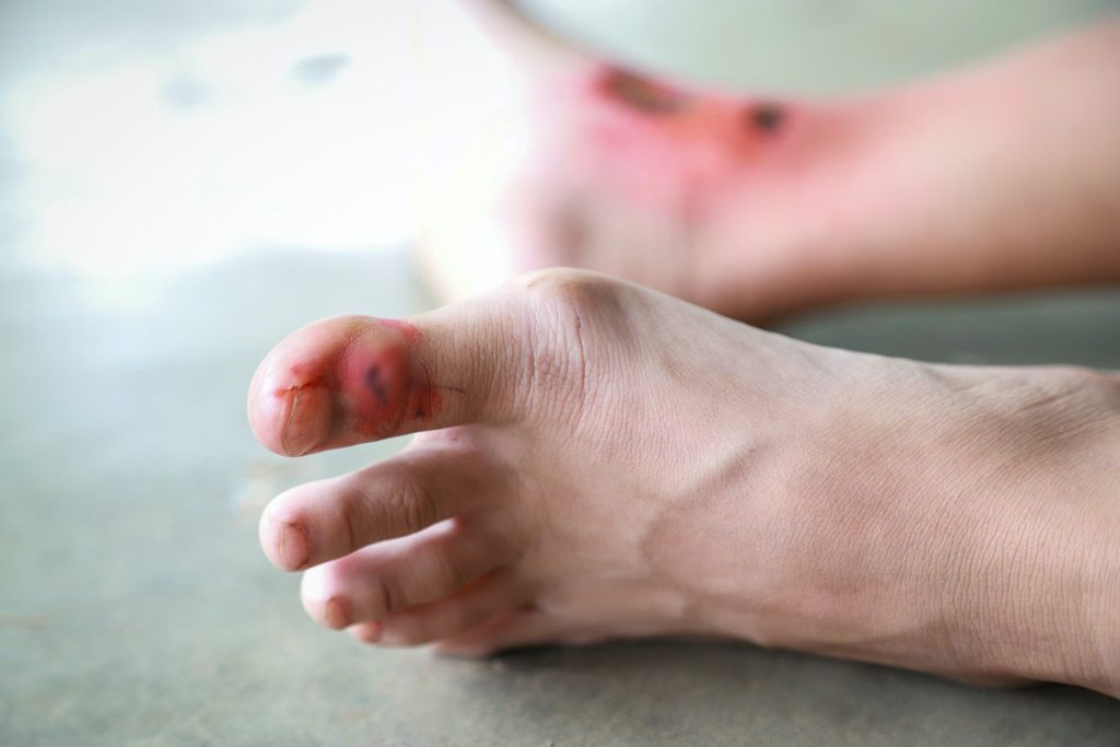 In immunocompromised individuals, even a small wound on the leg can rapidly progress into a necrotic ulcer.