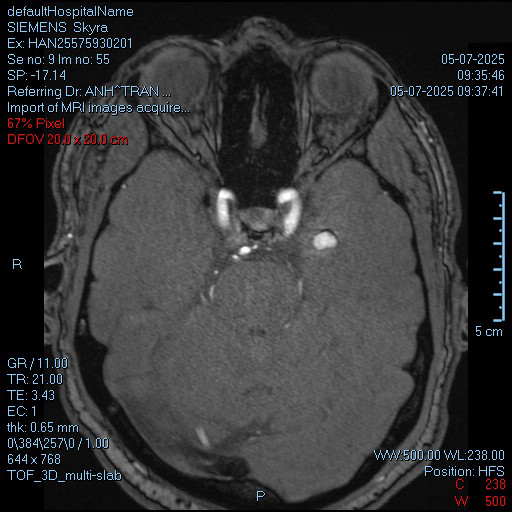 Hình ảnh MRI khối u mạch máu 9x14mm nhưng lại “ẩn mình” tại vị trí vô cùng nhạy cảm, sâu tới 5cm trong lớp vỏ não