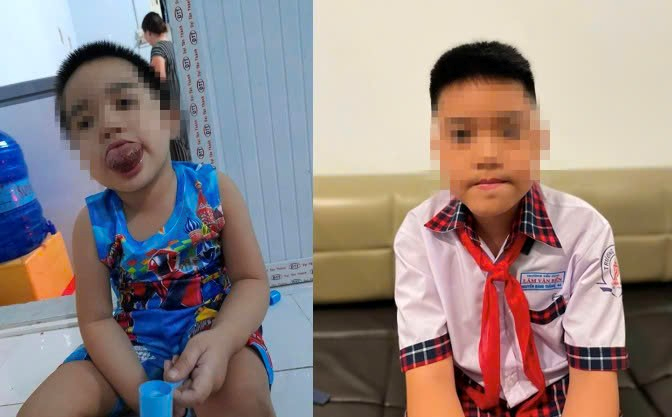 N.D.T. before and after undergoing tongue-reduction surgery